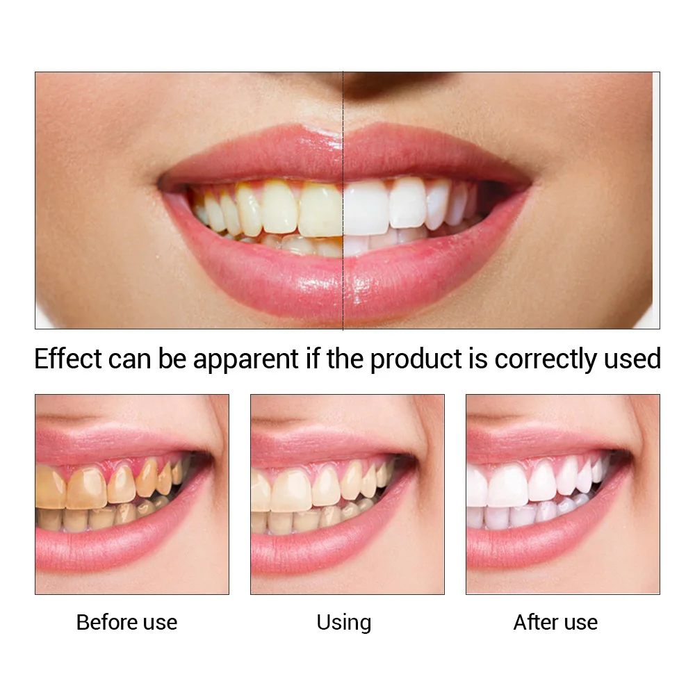 FTEENPLY 치아 미백 에센스 파우더 구강 위생 청 - Teeth Whitening Near Me 리뷰 및 가격