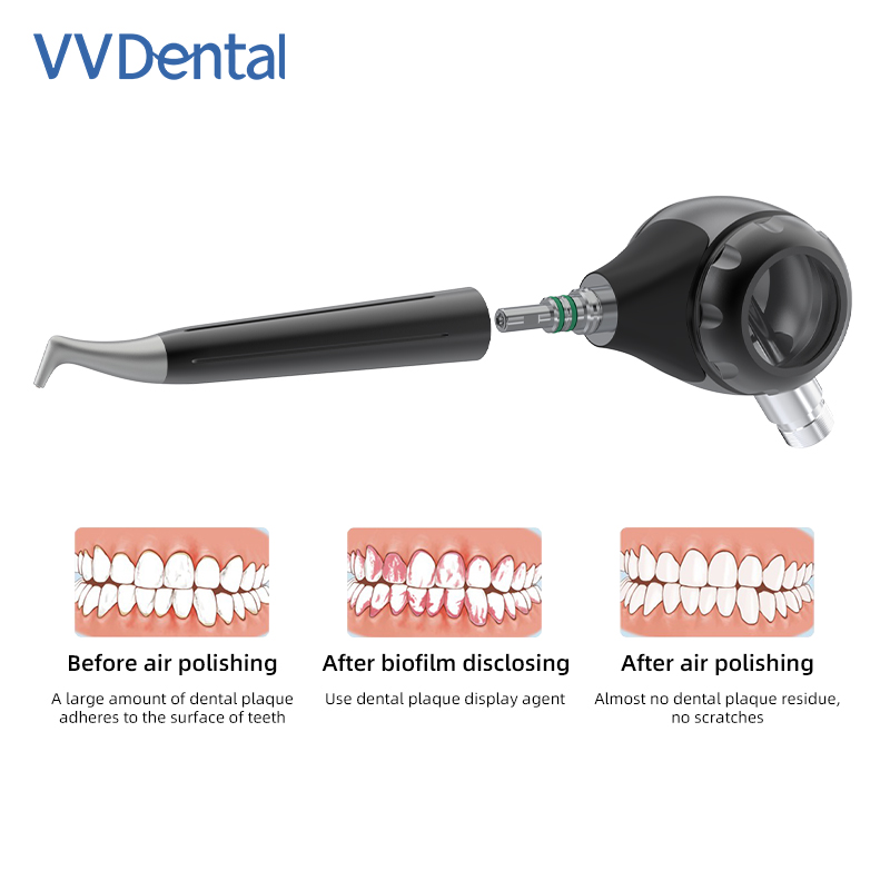 VVDental 에어 폴리셔 제트 에어 플로우 에어 구 - Colgate Whitening Teeth 리뷰 및 가격