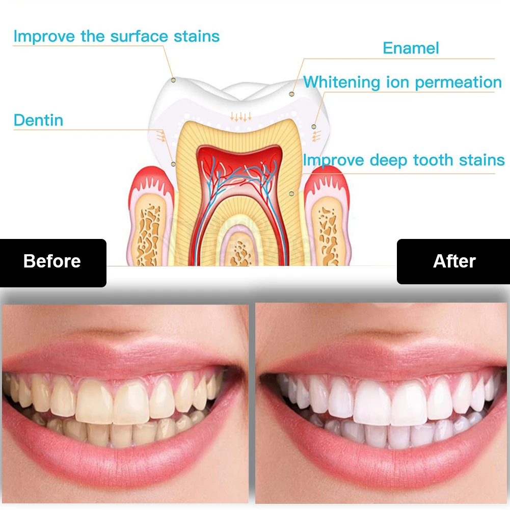 치과 치아 미백 키트 미니 16 LED 콜드 라이트 3 - Teeth Whitening Zoom 리뷰 및 가격