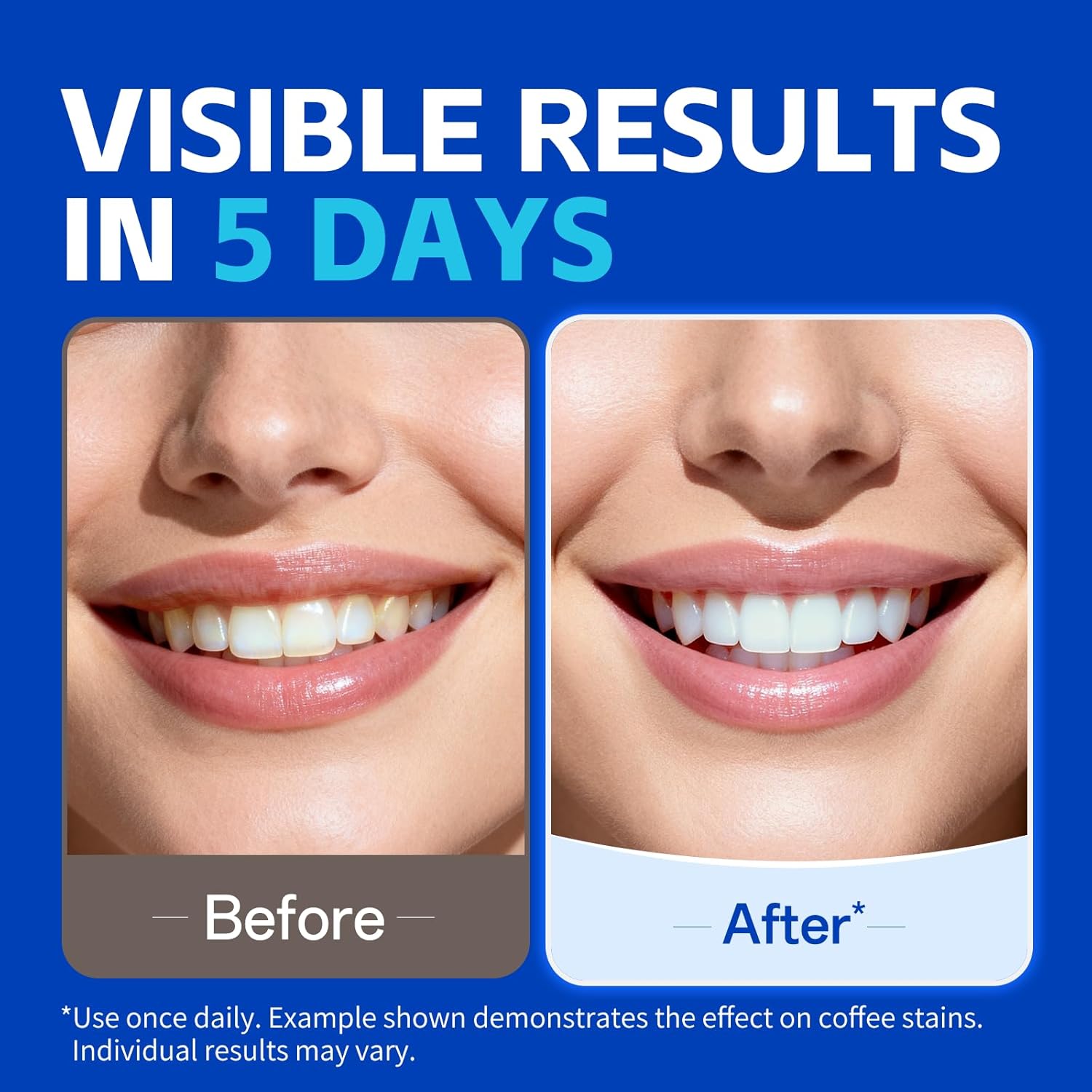 KHAZIX 치아 미백 스트립 7쌍, 사용하기 쉬운 미 - Teeth Whitening Oil Pulling 리뷰 및 가격